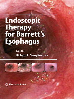 cover image of Endoscopic Therapy for Barrett's Esophagus